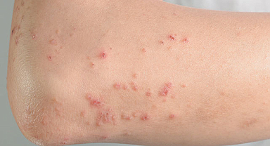 Behçet Hastalığı Nedir?