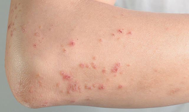 Behçet Hastalığı Nedir?