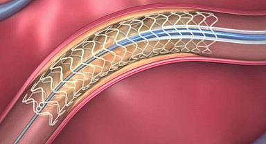 Stent takılan hasta kaç yıl yaşar?