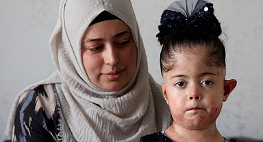 Tek dileği kelebek hastası kızına doyasıya sarılabilmek