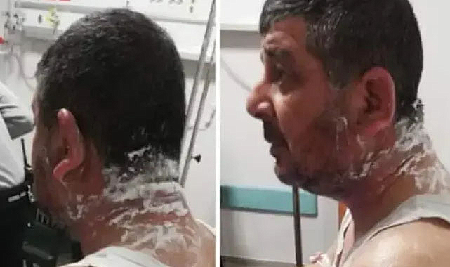 Ev sahibi tartıştığı kiracısına asitle saldırdı