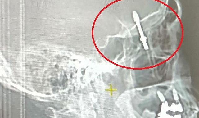 İmplant tedavisinde vida hastanın beynine saplandı