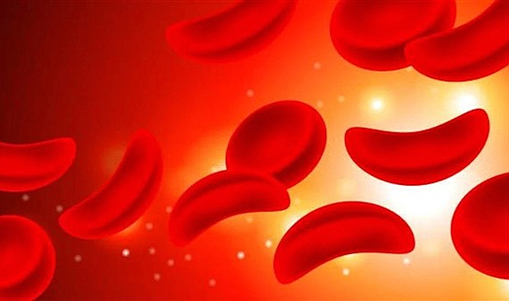 Yeni araştırma: A kan grubunun felç riski yüksek