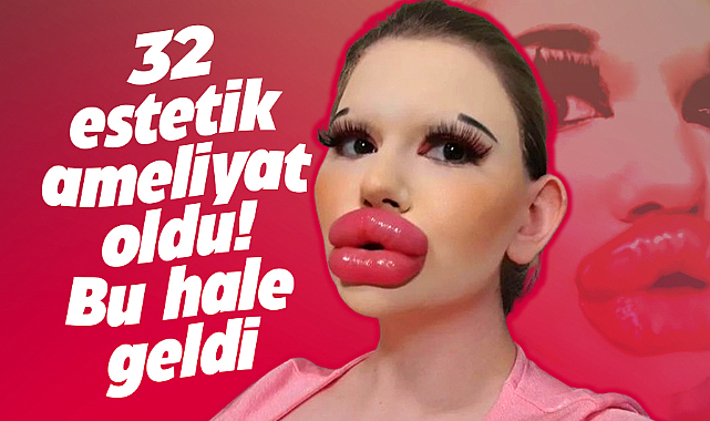 32 estetik ameliyat oldu! Bu hale geldi! Dev dudaklı kadın!