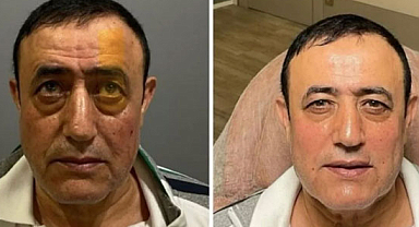 Mahmut Tuncer estetik operasyon geçirdi