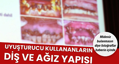 Samsun'da uyuşturucu kullananların ağız ve diş görüntüleri mide bulandırdı