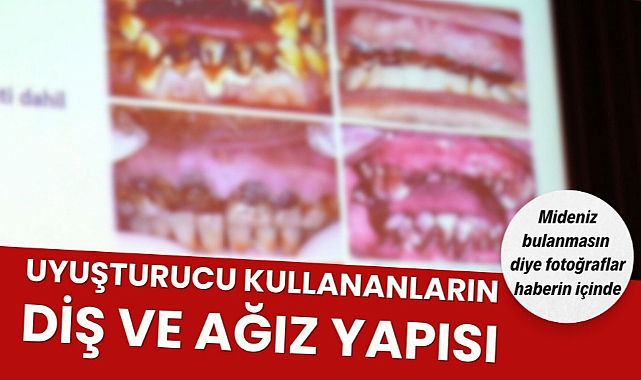 Samsun'da uyuşturucu kullananların ağız ve diş görüntüleri mide bulandırdı