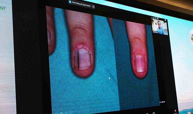 Uzmanlar uyardı 'Tırnak dibindeki siyah leke cilt kanseri öncüsü olabilir'