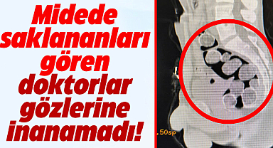 Samsun'da 18 paket MET mideden çıktı! Şoke eden röntgen görüntüsü