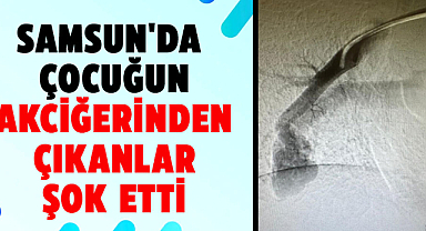 Samsun'da çocuğun akciğerinden çıkanlar şok etti
