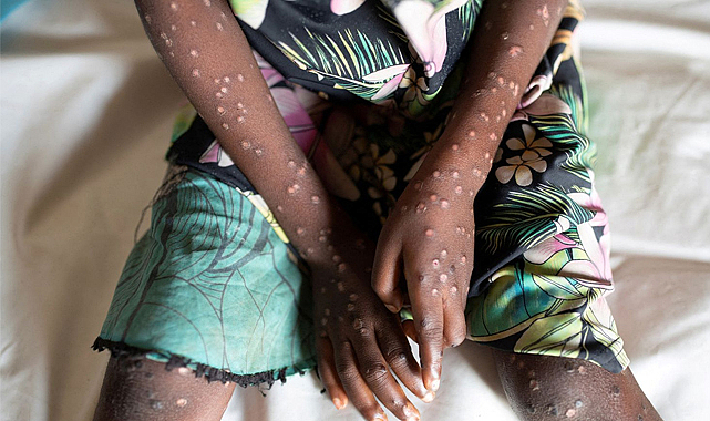 Afrika'da başlayan maymun çiçeği salgını Avrupa'ya sıçradı