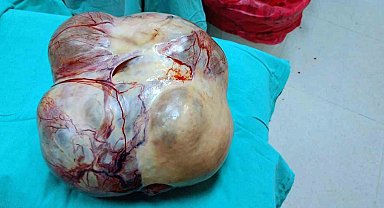 Ameliyattan korkup kaçtı, vücudundan 15 kiloluk dev kitle çıktı