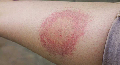 COVİD ve Maymun Çiçeğinden sonra yeni virüs alarmı!