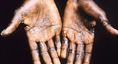 Dünya Sağlık örgütünden Maymun Çiçeğine yönelik acil durum ilanı