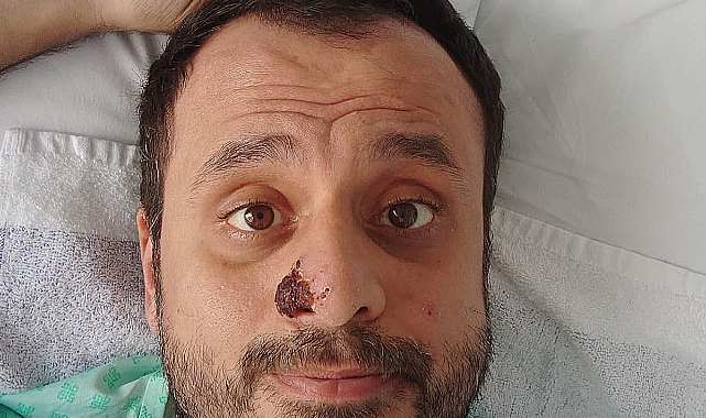 Londra'da Maymun Çiçeği’ne yakalanan Harun Tulunay süreci anlattı