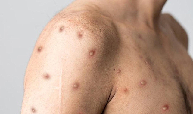 M çiçeği virüsü tehlikesi! Hızla yayılıyor