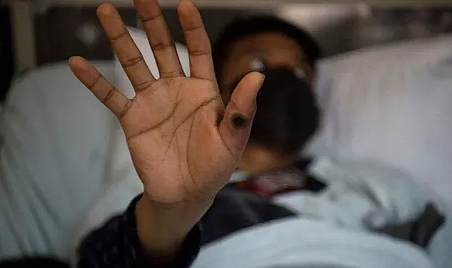 Maymun Çiçeği Avrupa’da, İsveç’ten ilk vaka