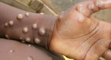 Maymun Çiçeği vakası alarm veriyor