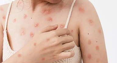 Maymun Çiçeği virüsü öldürür mü?