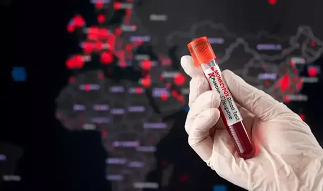 Maymun Çiçeği virüsü yayılmaya devam ediyor! Aşılar tam koruma sağlıyor mu?