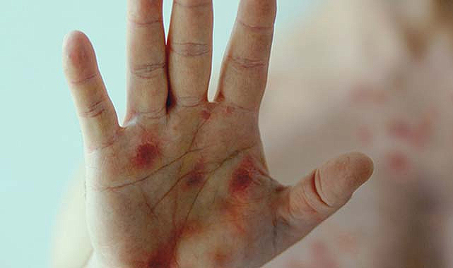 Maymun çiçeği virüsünün yayılma hızı artıyor