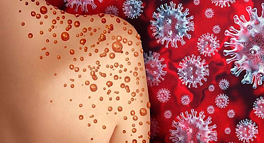 Maymun çiçeği yüzünden kapanma gelecek mi? Ölüm oranı nedir? DSÖ’den aşı önerisi