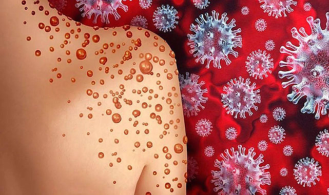 Maymun çiçeği yüzünden kapanma gelecek mi? Ölüm oranı nedir? DSÖ’den aşı önerisi