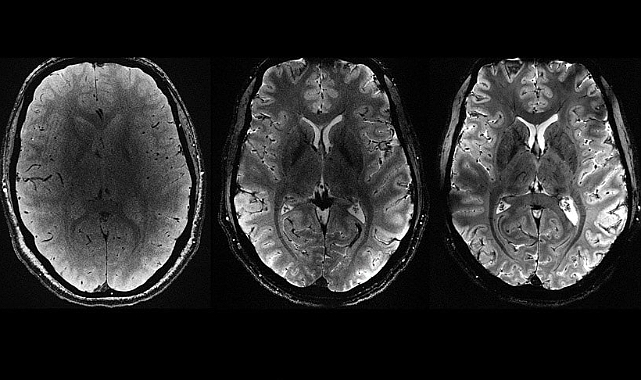 COVİD-19 için çarpıcı iddia! Beyni mi küçültüyor?