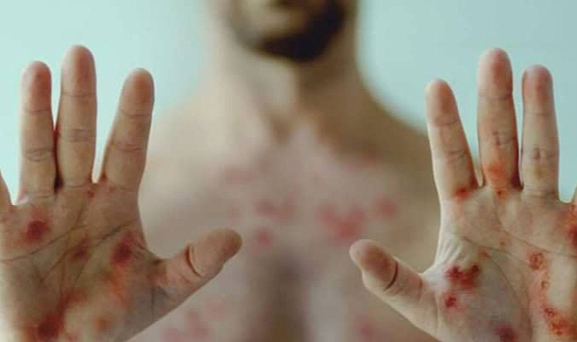 Maymun Çiçeği Virüsü için DSÖ açıklaması! Aşı onaylandı