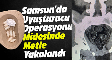 Samsun'da midesinde metle yakalandı
