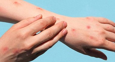 M-çiçeği virüsünün yeni varyantı tespit edildi