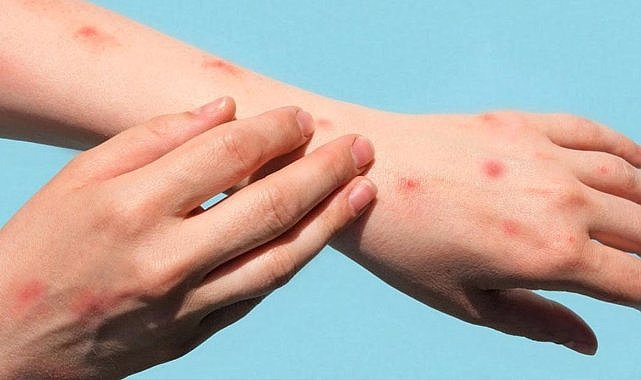 M-çiçeği virüsünün yeni varyantı tespit edildi