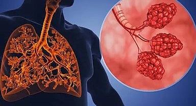 Astım ve KOAH'a devrim niteliğinde tedavi