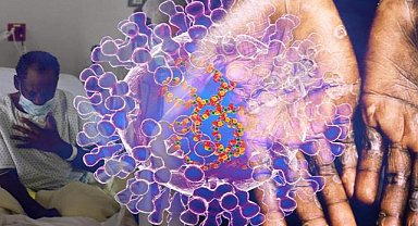 DSÖ’den Maymun çiçeği için acil durum alarmı!