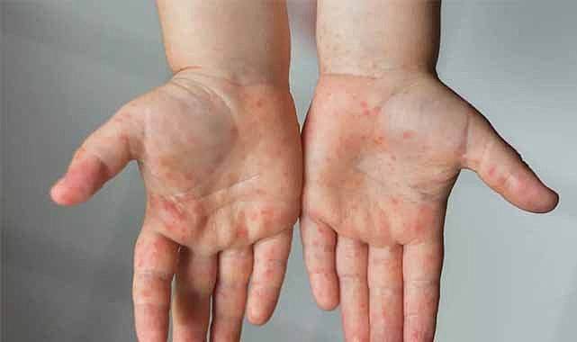 Uzmanı uyardı! El-ayak-ağız hastalığına dikkat!