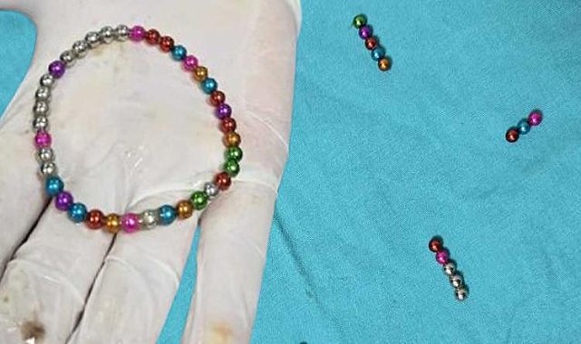 Bursa'da şaşkına çeviren olay! 5 yaşındaki çocuğun bağırsağından 38 mıknatıs çıkarıldı