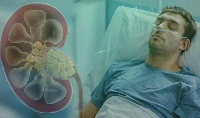 Erkeklerde daha fazla görülüyor: İdrarda kanama ve ağrıya dikkat!