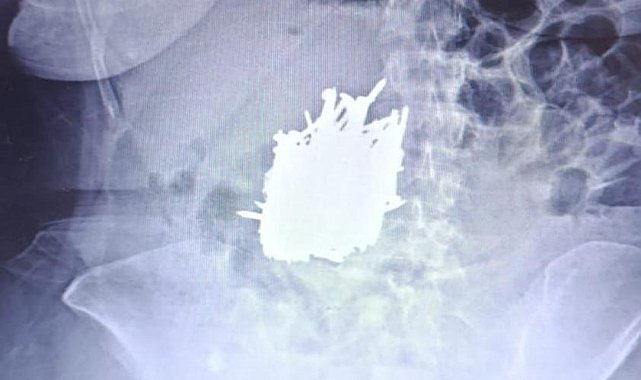 Karın ağrısı şikayetiyle hastaneye başvurdu... Midesinden 1 kilo metal cisim çıktı