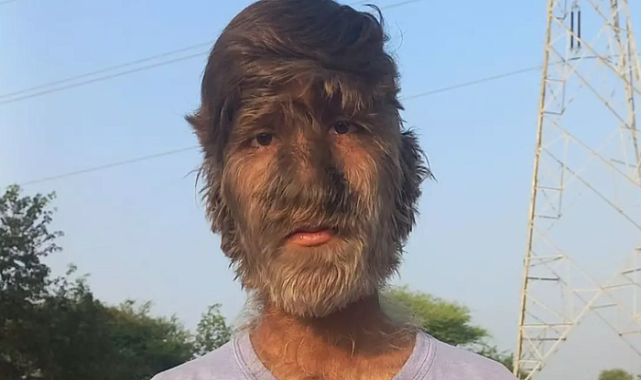 Orta Çağ'dan beri nadir görülüyordu: 11 bebekte "Kurt adam sendromu" çıktı!