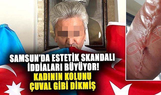 Samsun'da estetik skandalı iddiaları büyüyor! Kadının kolunu çuval gibi dikmiş