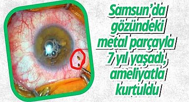 Samsun’da gözündeki metal parçayla 7 yıl yaşadı, ameliyatla kurtuldu