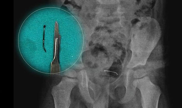 Tam 9 ay önce yutmuş... 5 yaşındaki çocuğun mesane duvarına yapışmış