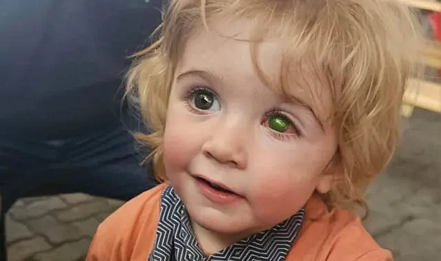 2 yaşındaki çocuk ‘öpücük’ yüzünden kör oldu!