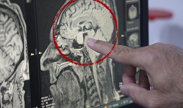 Türkiye'de sağlıkta bir ilk! Kapalı yöntemle beyindeki tümör alındı