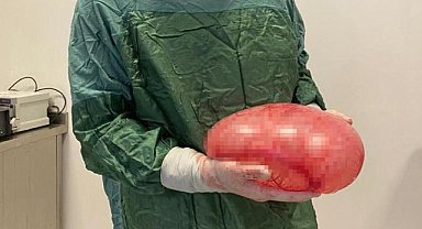 Karnında şişlik var sandı, 30 santimlik tümör çıktı
