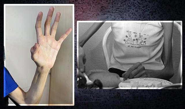 Sessiz bir salgın gibi yayılıyor! Ergenlerde anoreksiyaya dikkat