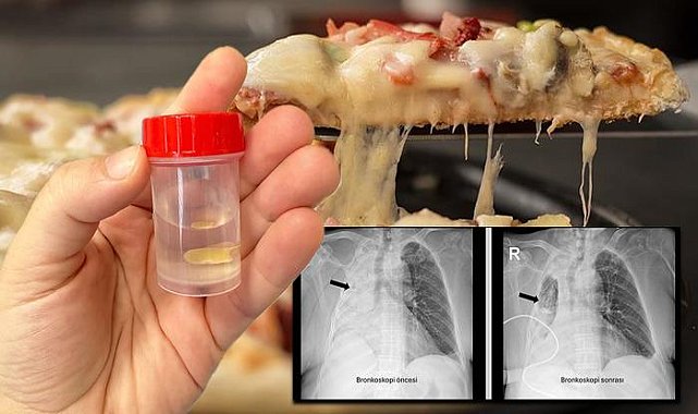 Yediği yemek az kalsın hayatından ediyordu: Sağ akciğeri tamamen kapandı!