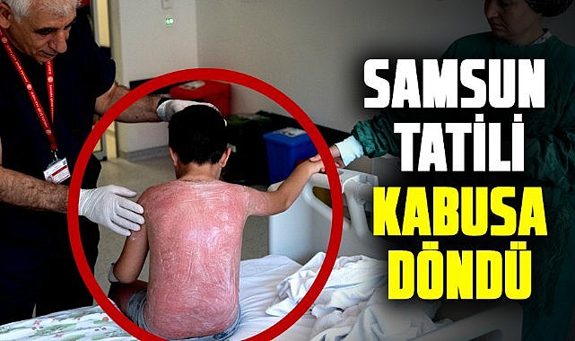 Samsun’da güneşte 4 saat kalan çocuk, ikinci derece yanıkla hastanelik oldu