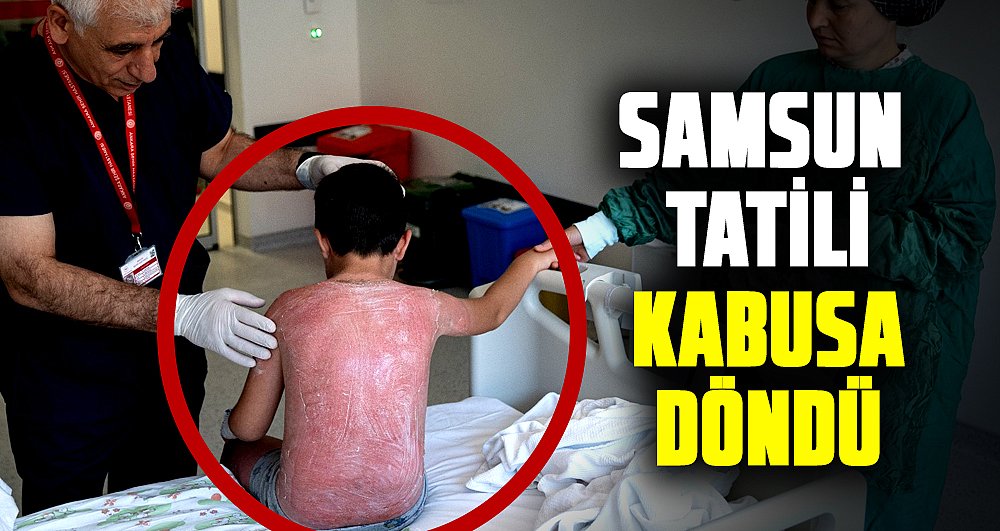 Samsun’da güneşte 4 saat kalan çocuk, ikinci derece yanıkla hastanelik oldu