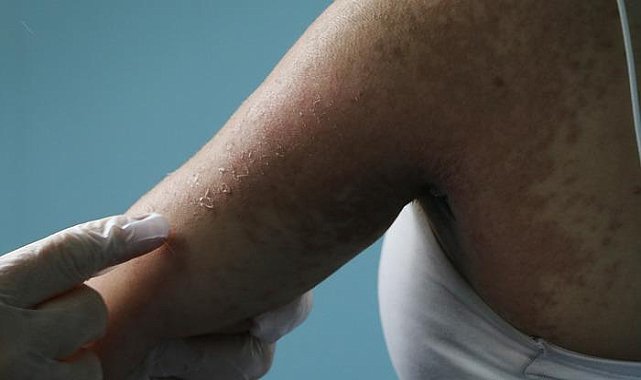 Sosyal medyadan aldığı 'cilt beyazlatıcı' krem az daha öldürüyordu!